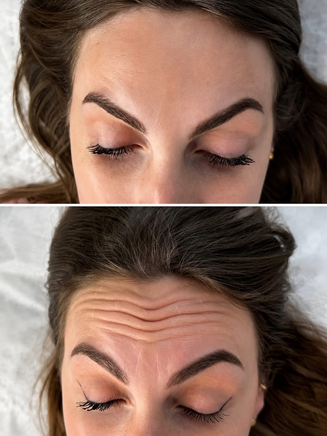 Avant/après — Botox (photo 1)