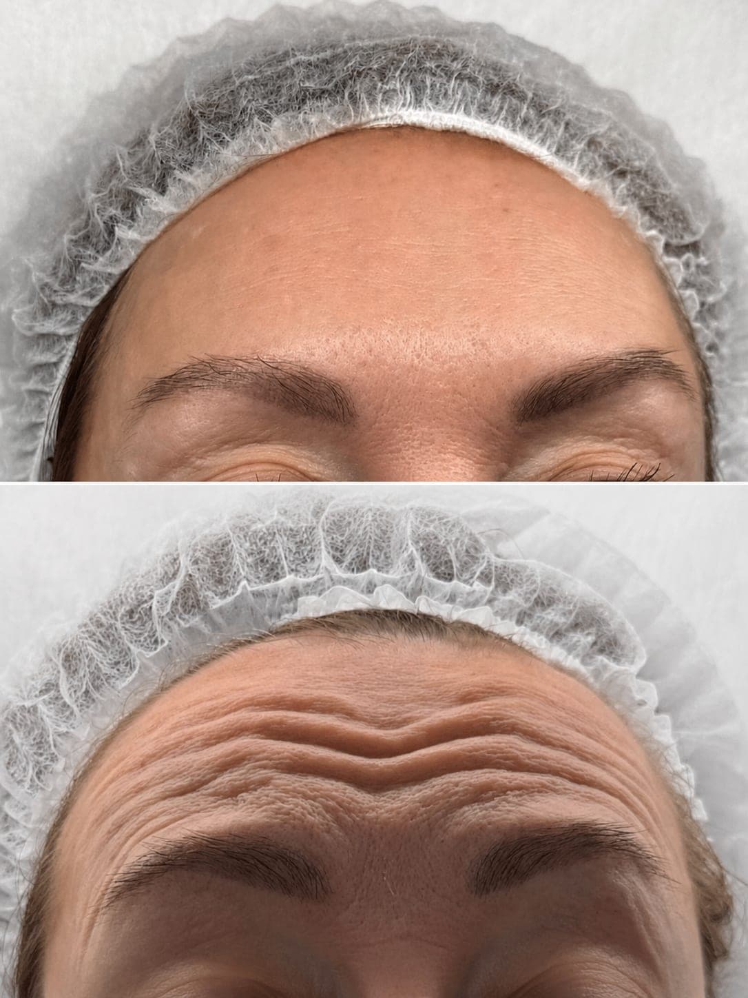 Avant/après — Botox (photo 2)