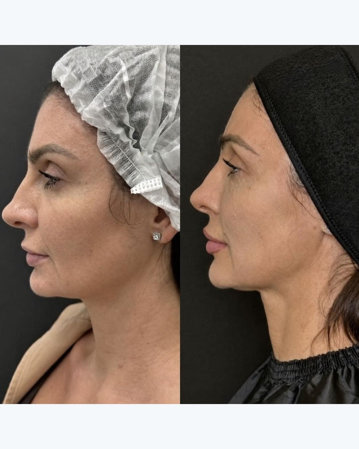 Avant/après — Endolift (photo 1)