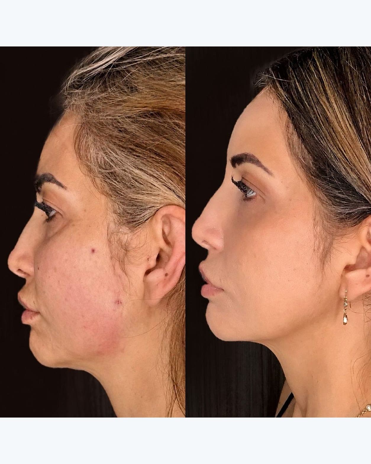 Avant/après — Endolift (photo 2)