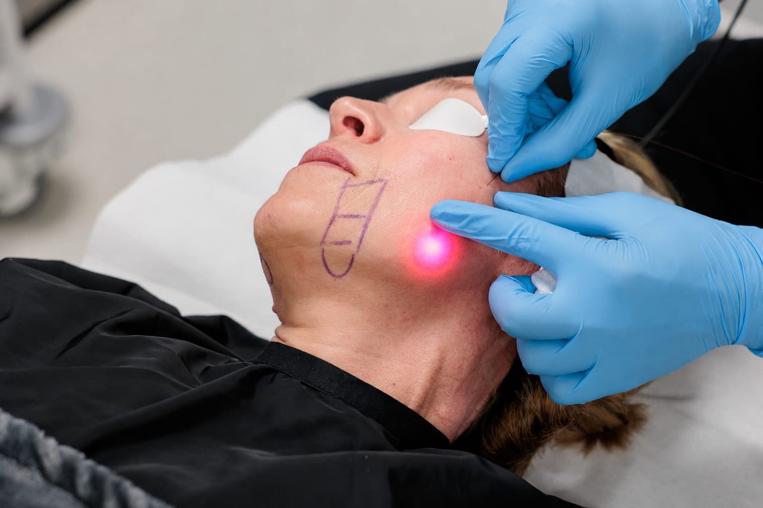 Avant/après — Endolift (photo 3)