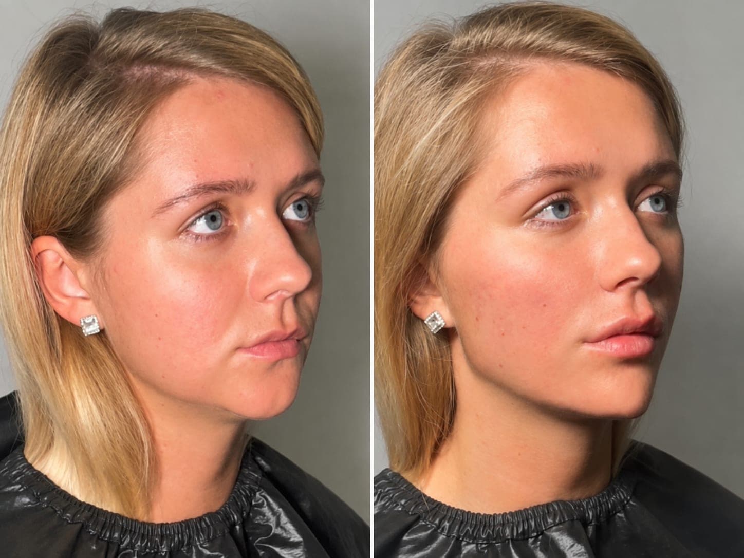 Avant/après — Full Face & Contouring Facial (photo 2)