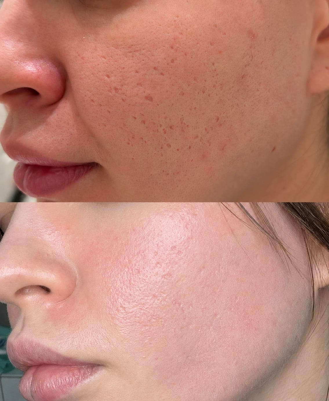 Avant/après — Laser CO₂ Fractionné (photo 1)
