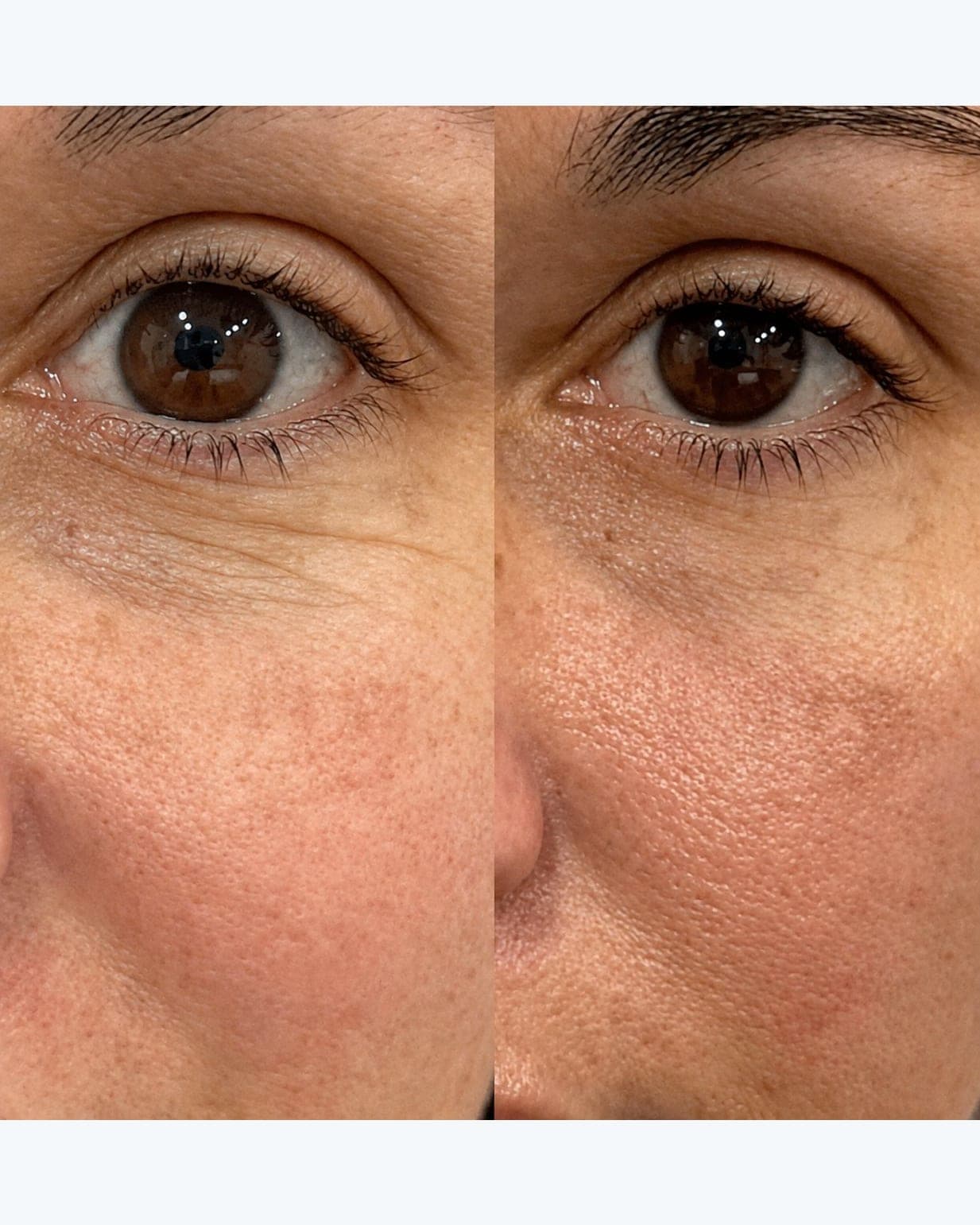 Avant/après — PDRN — Régénération cellulaire (photo 3)