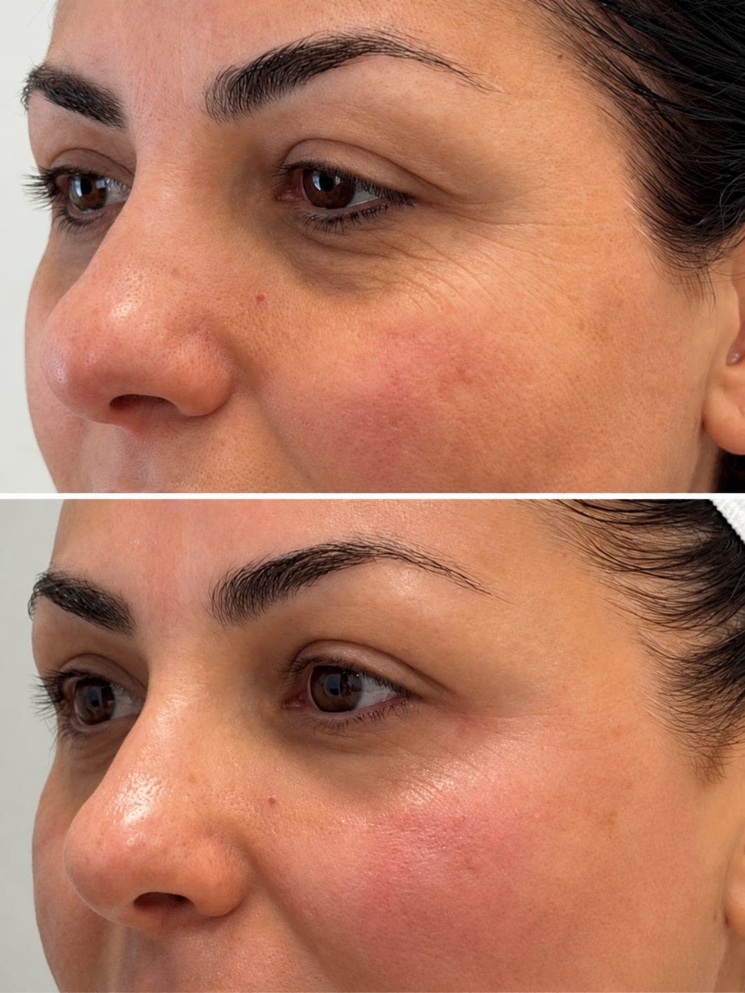 Avant/après — Peeling PRX (photo 2)