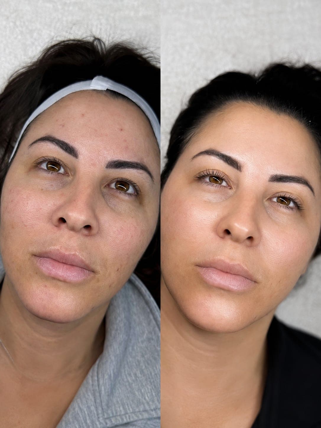 Avant/après — Peeling PRX (photo 3)
