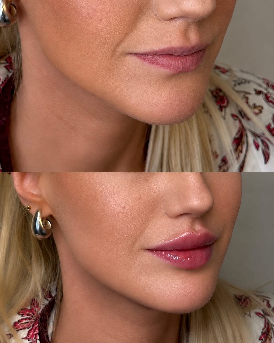 Avant/après — Lèvres – Russian Lips (photo 1)