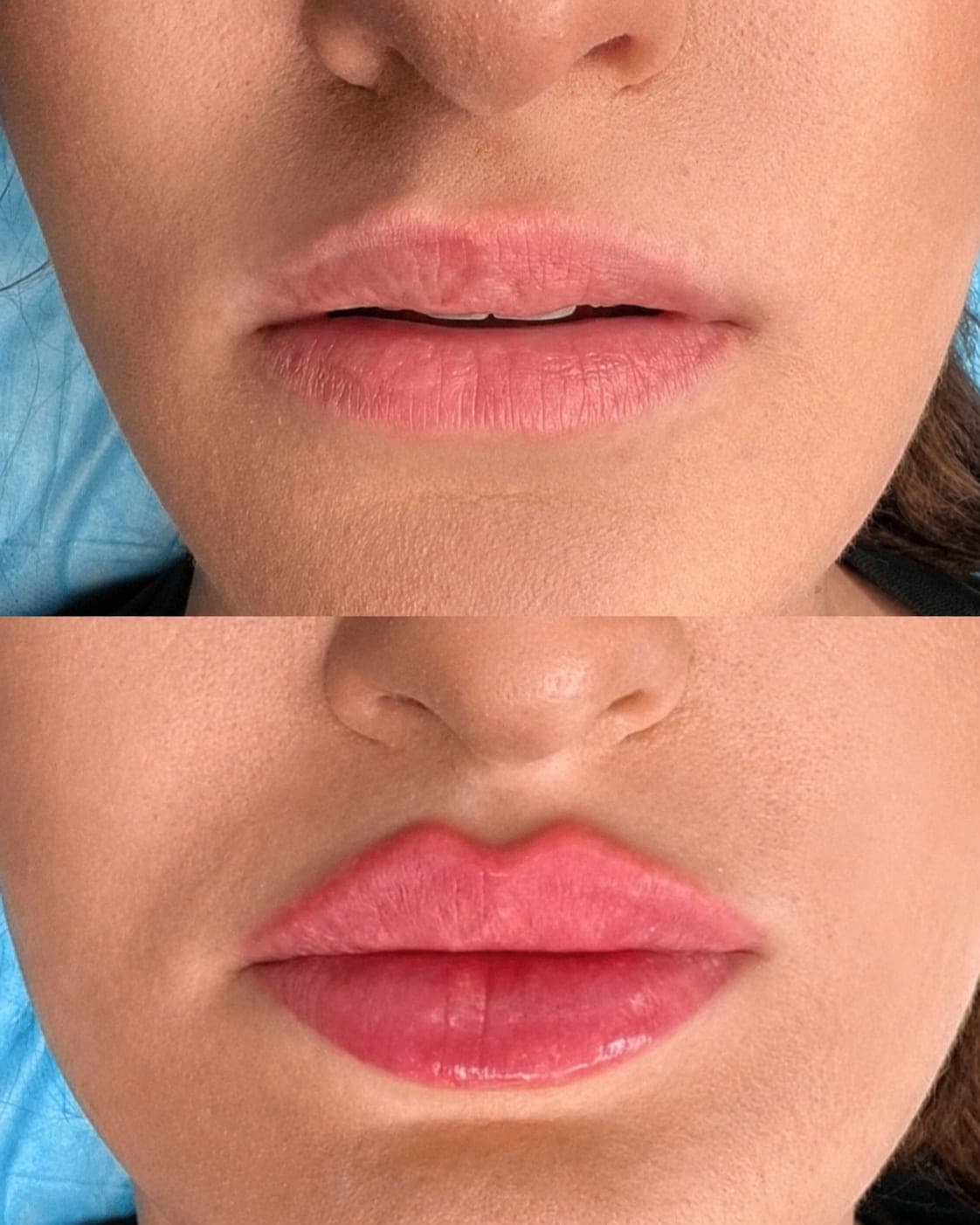 Avant/après — Lèvres – Russian Lips (photo 2)